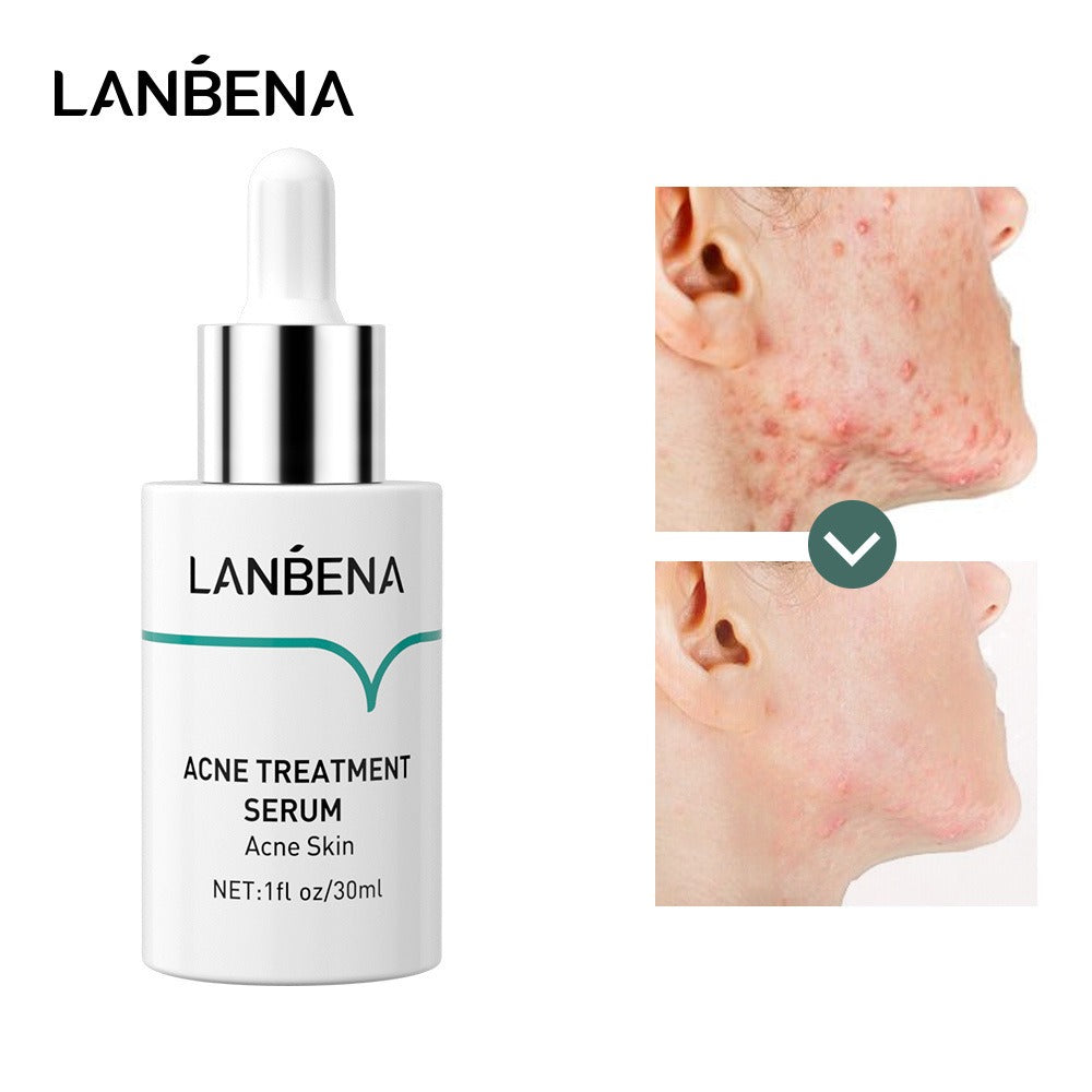 LANBENA LATTE TRATTAMENTO DELL'ACNE